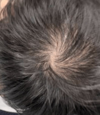 つむじはげはどこから？専門家の視点＆世間の声おでこ・つむじ・頭頂部・分け目のお悩み