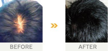 高校生の若ハゲの原因は？今すぐできる薄毛対策や治療法を紹介AGA・抜け毛・薄毛治療のAGAメディカルケアクリニック 公式