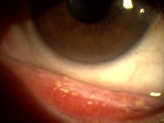 眼瞼黄色腫の除去治療 切除- 池袋の美容皮膚科・美容外科なら「みずほクリニック」