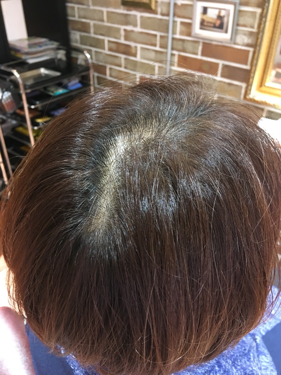 つむじが2つある原因とは？2つ以上あるとはげるのは本当？駅前AGAクリニック 新宿、北千住、大阪、京都、岡山、鹿児島など