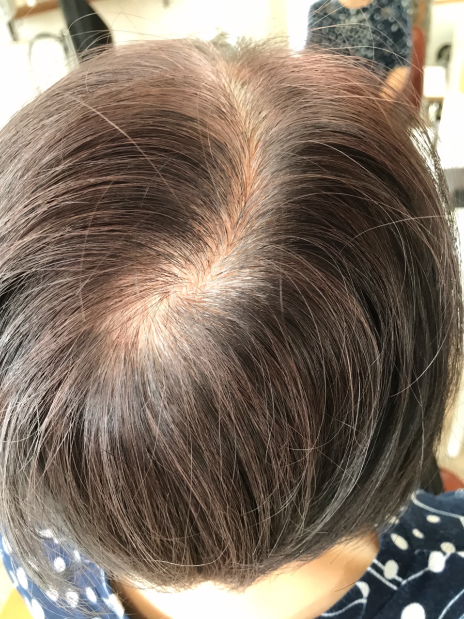 女性 薄毛 つむじ割れが消える！？簡単ヘアアレンジ！薄毛に悩む女性の為のヘアサロン・美容院TELAS テラス 東京・大阪