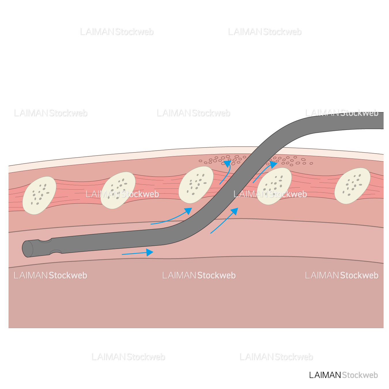 胸腔ドレーン抜去の基準は？ – 呼吸器外科 E-Learning