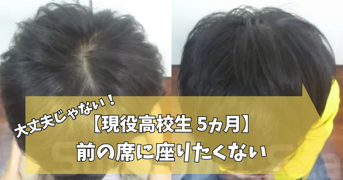 事実 中学生でも薄毛になる原因と改善方法を徹底解説公式 スーパースカルプ発毛センター寝屋川枚方店