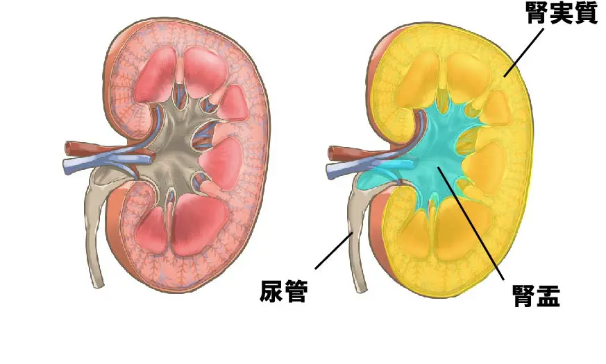 巨大腎結石への挑戦研究報告医療法人社団實理会 東京国際大堀病院