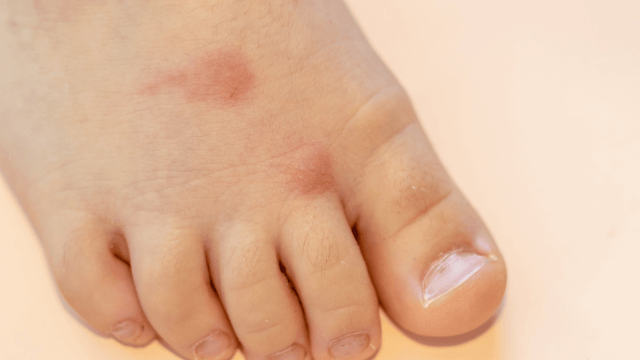 やけどの応急処置方法は？水ぶくれができた時の対処法を解説きずときずあとのクリニック 豊洲院・銀座院東京都江東区・中央区の形成外科・美容外科