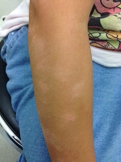 症例写真一覧：Qスイッチルビーレーザー美容外科・形成外科、美容整形なら ヒルズ美容クリニック