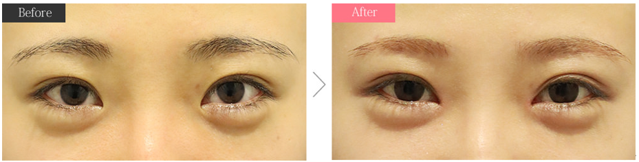 簡単🔰 重たい一重のためのふたえメイクのやり方！自然でバレにくい♡落とし方まで徹底解説