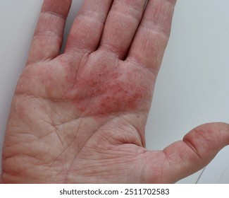 掌蹠膿疱症とは掌蹠膿疱症コミュニティのサイト