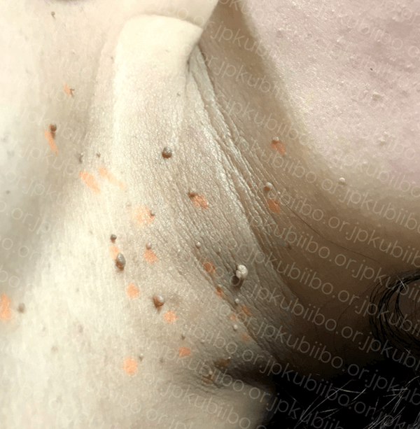 軟性線維腫 首イボ こばとも皮膚科栄駅 名古屋市栄区 徒歩2分