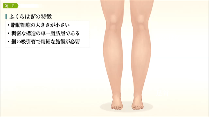 脂肪吸引 ふくらはぎ痩せ 」に関する美容整形の症例写真の詳細新宿・池袋・大宮で人気の美容整形は東京シンデレラ美容外科