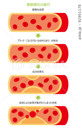血管が詰まっているイラスト🎨 フリー素材 看護roo! カンゴルー