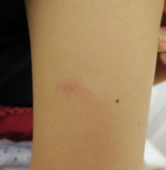 外骨腫、粉瘤、脂肪腫、わきが治療やレーザー脱毛なら 日本橋形成外科 皮フ科・美容外科