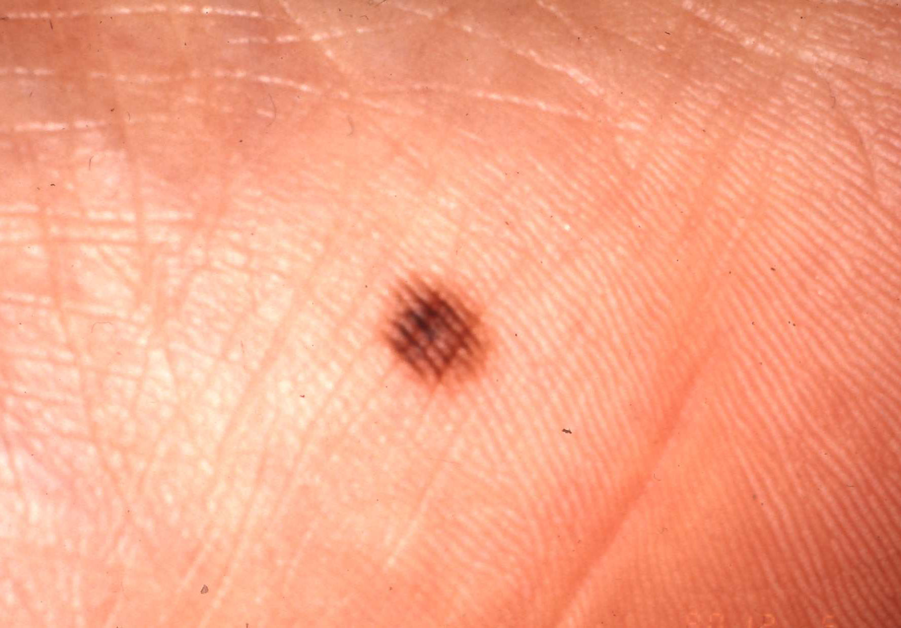 がんとほくろを見分ける方法はある？疑うポイントと治療法がんメディ