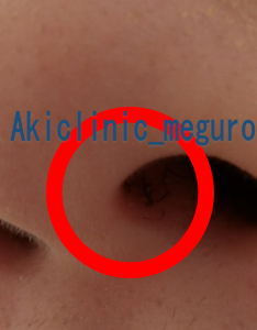 医師監修 鼻の中にもニキビができる？！できものが痛いときの対処法や原因まで解説ハダメディア by BIHADADO.TOKYO