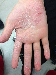 アトピー性皮膚炎とフェイシャルリフレクソロジー&サーミー温熱反射療法認定セラピストの症例 Case with Facial Reflexology& Thermie Reflex Therapy for Atopic dermatitis Eczema -フェイシャルリフレクソロジーJAPAN