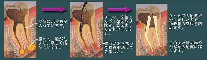 膿がたまったニキビの原因と対処ニキビ一緒に治そうProject製薬会社のマルホ