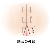 形成外科の縫合：傷跡修正ヒルズ美容クリニックは神奈川・湘南・藤沢の美容外科・美容皮膚科・形成外科