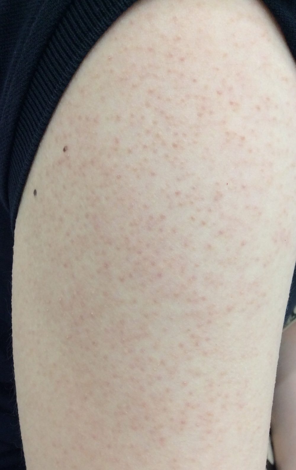 毛孔性苔癬 もうこうせいたいせん 形成外科・リンパ浮腫 ＬＳクリニック 大阪梅田