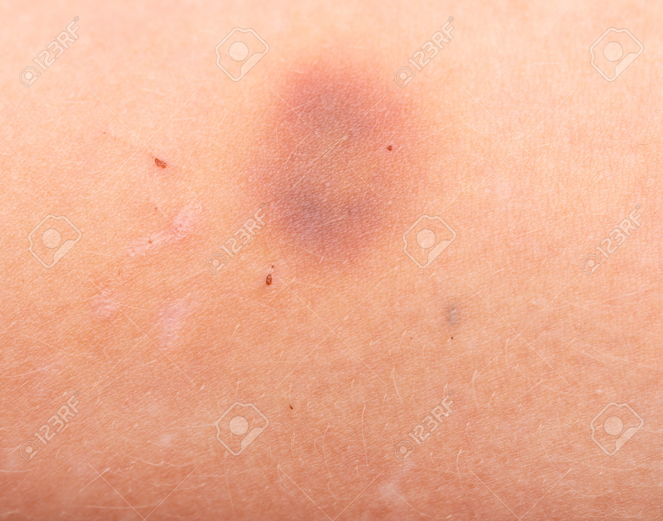 質問です。 - 腕や足などに、黄色いあざ？が気づかないうちにできていて、- Yahoo!知恵袋