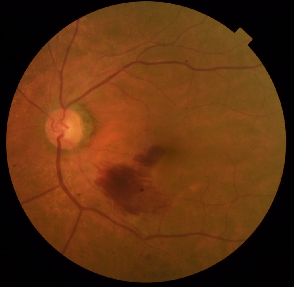 症状日本眼科学会による病気の解説