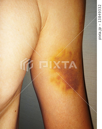 腕・足・膝・指・胸に現れる黄あざのメカニズム―皮膚の異変と対処法湘南カイロ茅ヶ崎整体院