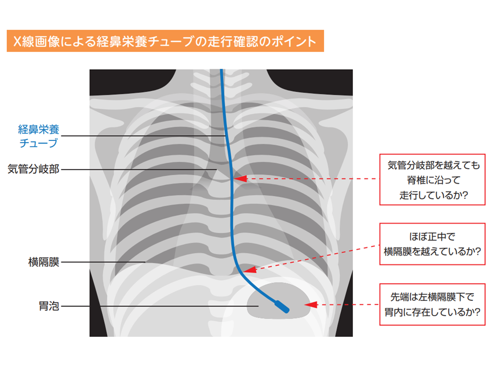 小児への経鼻チューブの固定方法「鼻翼基部固定」で抜去や剥がれなどのリスクを低減skinix スキニックス