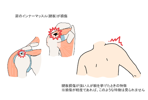 腕が痛みで上がらない『上腕二頭筋長頭腱炎』のメカニズム解説KIZUカイロプラクティック整体本院