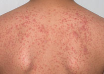 植毛後の毛嚢炎について横浜・首都圏の自毛植毛・植毛の専門医、ヨコ美クリニック