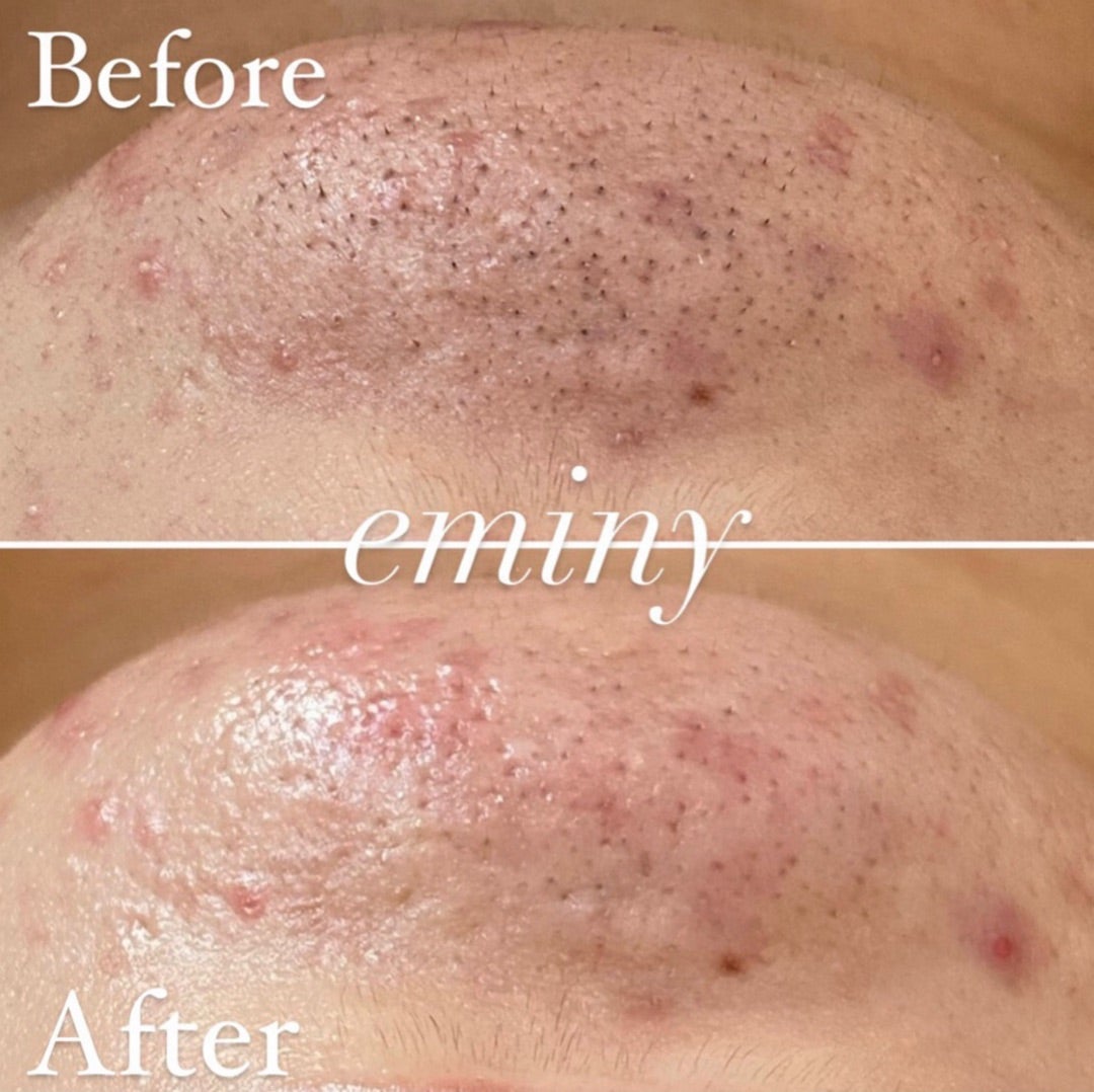 鼻の毛穴の詰まり汚れと黒ずみ汚れを諦めないで！主な原因「角栓」を知って攻略する方法Kao Beauty Brands - プレイパーク