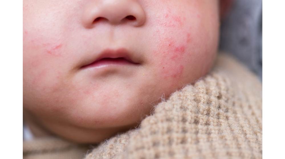 あせもとは？あせもの原因と対処法 パンパース