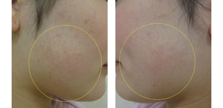 アトピーがぐんぐん良くなる本: フケ状の肌がきれいになった