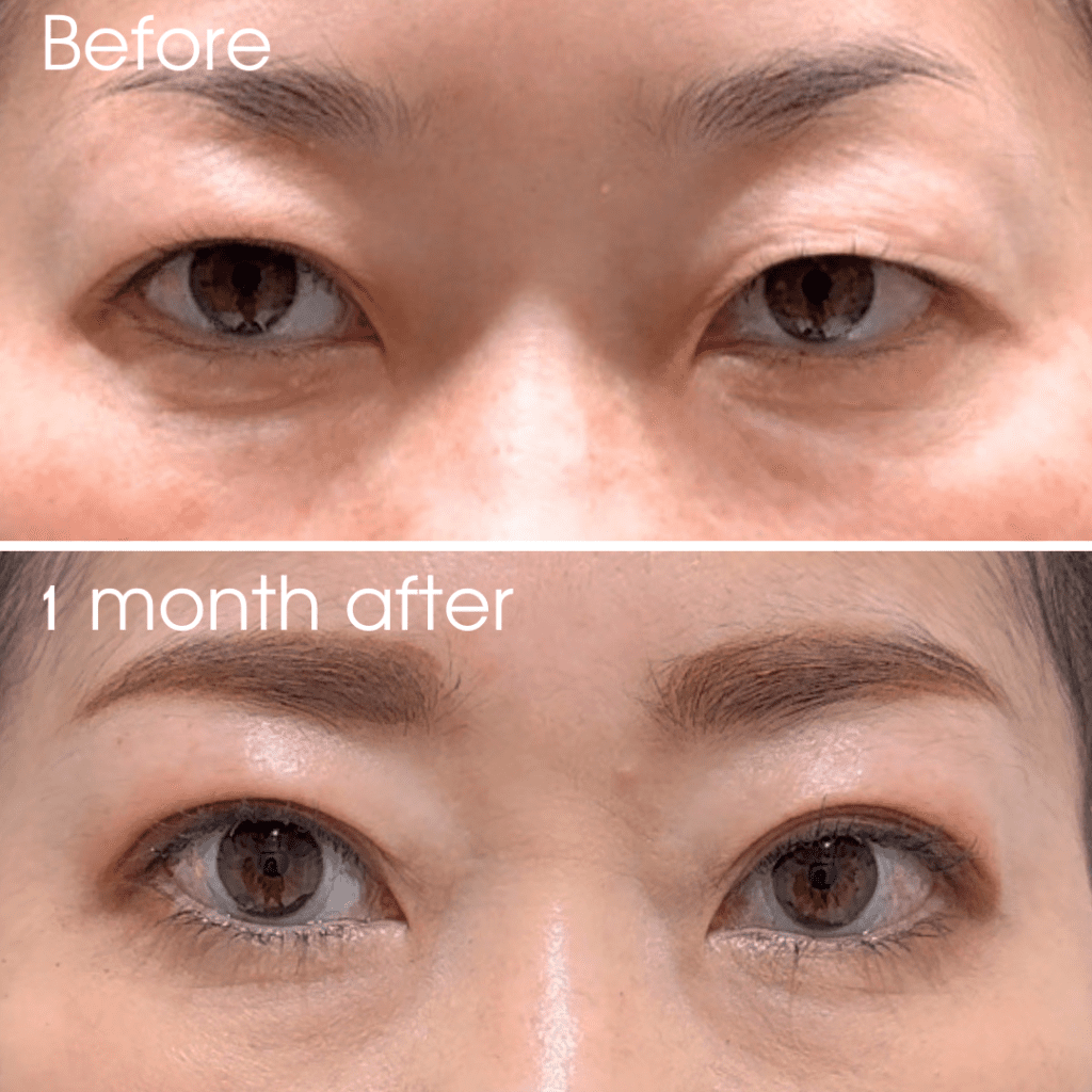 腫れぼったい男性 一重まぶた を二重全切開法でスッキリ改善横浜市鶴見の形成・美容外科 エムズクリニック