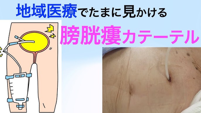 胃ろうとは？胃ろうの適応と管理のポイント 日常ケアやトラブルの原因と対策を解説カーディナルヘルス医療関係者向け製品情報サイト