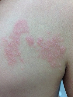 首に帯状疱疹が現れたら？早めの治療を考えよう！ - 中村AJペインクリニック