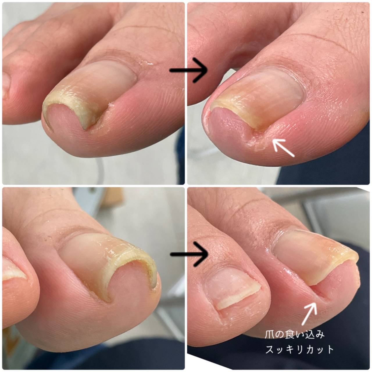 巻き爪を予防！正しい爪の切り方 外反母趾や巻き爪、足の悩み専門整体 千葉県船橋市西船徒歩2分足専門スタジオ ピースのニュースまいぷれ 船橋市