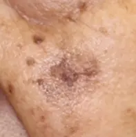 扁平苔癬 へんぺいたいせん こばとも皮膚科栄駅 名古屋市栄区 徒歩2分