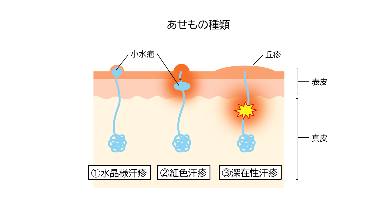 汗疹気になる皮膚症状を調べる│マルホ株式会社皮膚_部位・症状 疾患検索