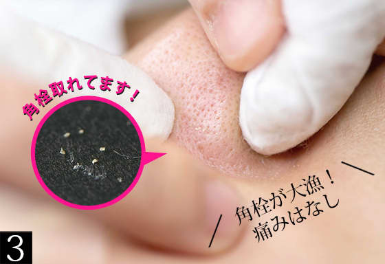 角栓 ブラックヘッド 角栓除去 ニキビ芯出しーニキビにきび治療BlackHeadsWhiteheadsAcnesDrChong Clinic - YouTube