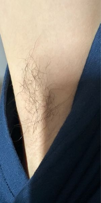 脇毛に白い塊が出るとワキガ？白い塊の正体や効果的な対策について紹介mismos ミスモス