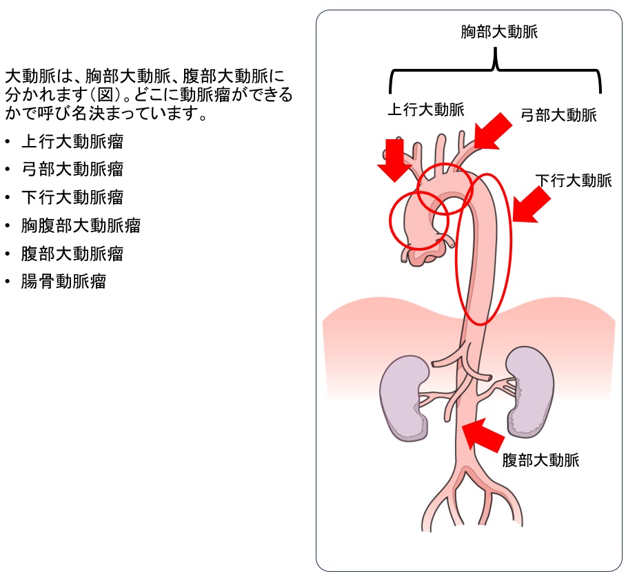 大動脈瘤とは - 心臓血管外科医 下川智樹 帝京大学附属病院
