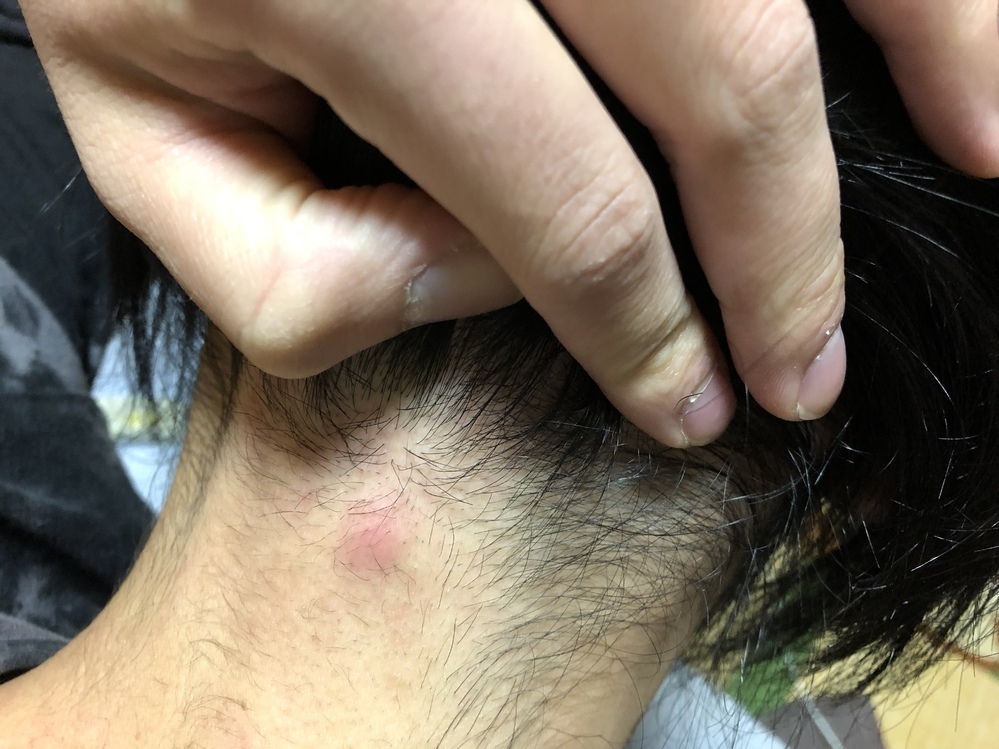 体の吹き出物が治らない理由👨🏻‍⚕️なかなか体の吹き出物が治らない😥という方 もしかしたらニキビではないかもしれません💦体にできるポツポツは、ニキビであることが1番多いですが マラセチア毛包炎の場合もあります💡 ニキビとマラセチア毛包炎は治療も異なる