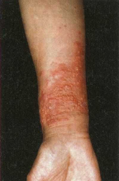 線状皮膚炎こばとも皮膚科栄駅 名古屋市栄区 徒歩2分