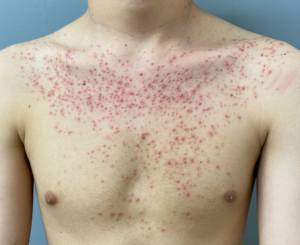 ニキビとマラセチア毛包炎の見分け方は？治療法についても紹介