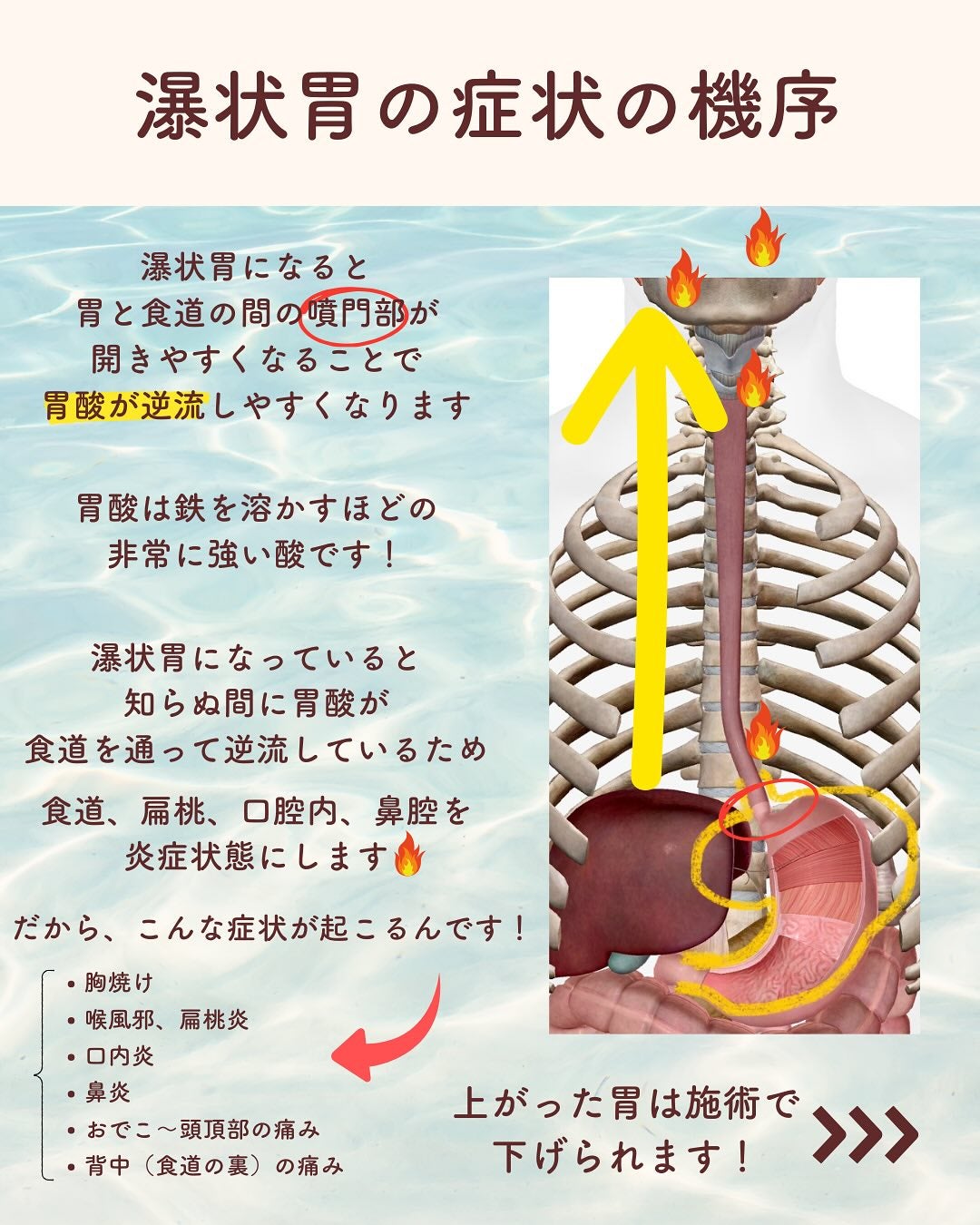 逆流性食道炎 胸やけ・ゲップ・喉の違和感 さかい胃腸・内視鏡内科クリニック基山町・小郡市・鳥栖市