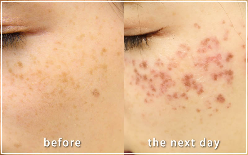 湘南美容クリニックのシミ取り放題10個26,000円の口コミ評判は？経過・料金やシミ取りレーザー10の特徴を解説Beauty ParkClinic