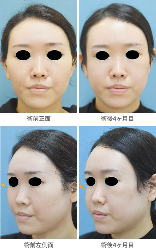 比較的しっかりしたエラ張りの方の小顔整形術 エラ骨切り・下顎下縁形成術輪郭整形・小顔整形ブログ池袋の小顔整形・顔 痩せ・輪郭整形みずほクリニック