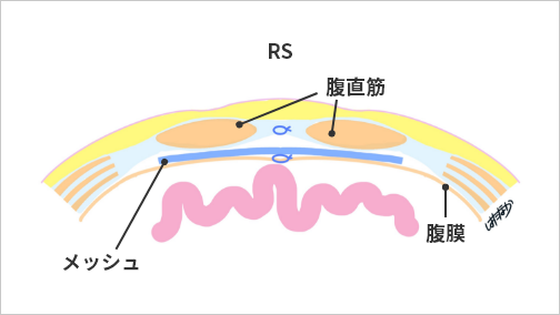 臍 さい ヘルニアの治療についてなんば坂本外科クリニック