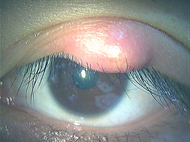 霰粒腫・麦粒腫 さんりゅうしゅ・ばくりゅうしゅ 丸山眼科医院 大阪府高槻市 形成外科