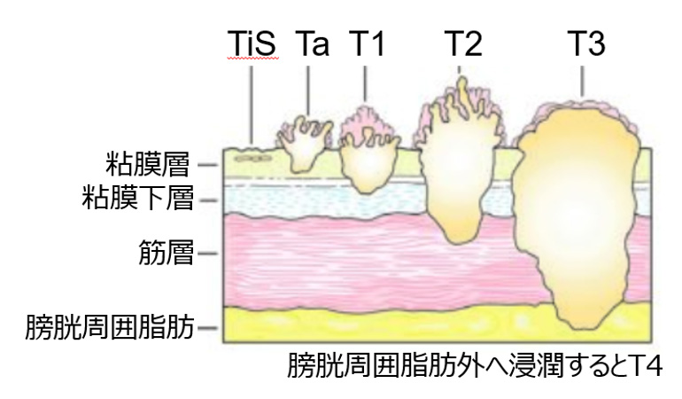 膀胱がんとは 膀胱の構造、症状など膀胱がんMSD oncology がんを生きる