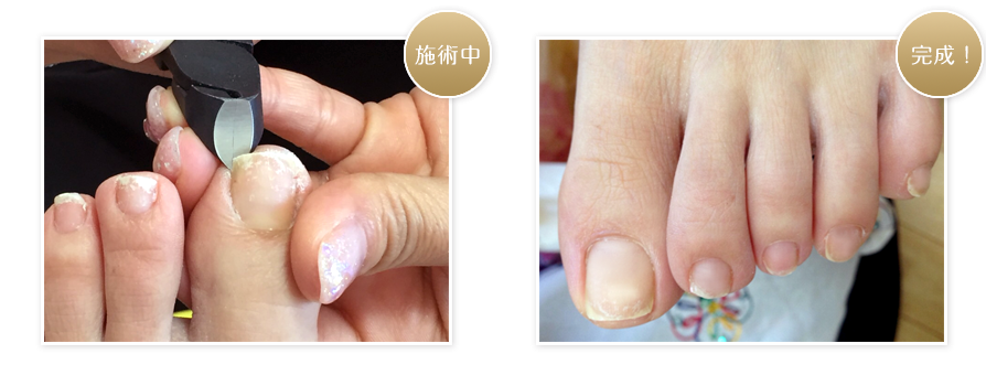 夏の時期にネイルをすると巻き爪の部分が痛みます・ - ネイルサロン エクラーラ品川・大井町店 公式ブログ